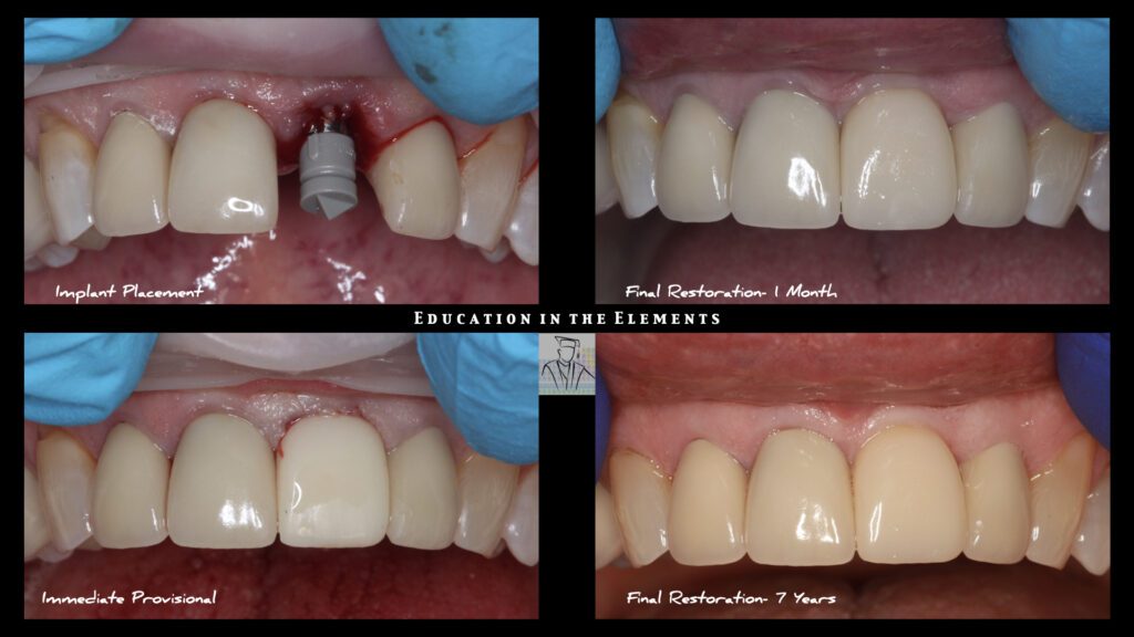 Collage of dental implants