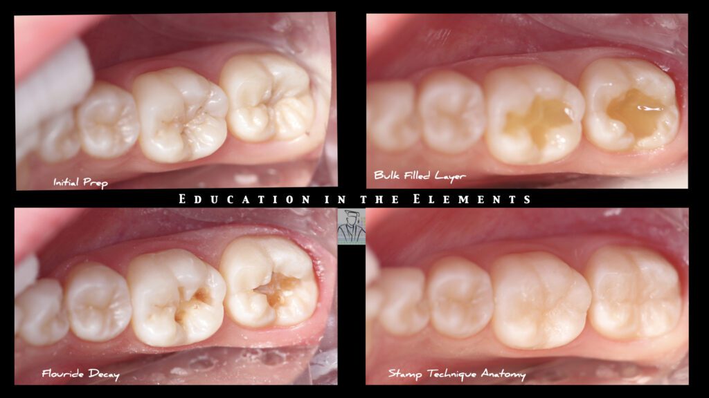 Collage of teeth holes filled