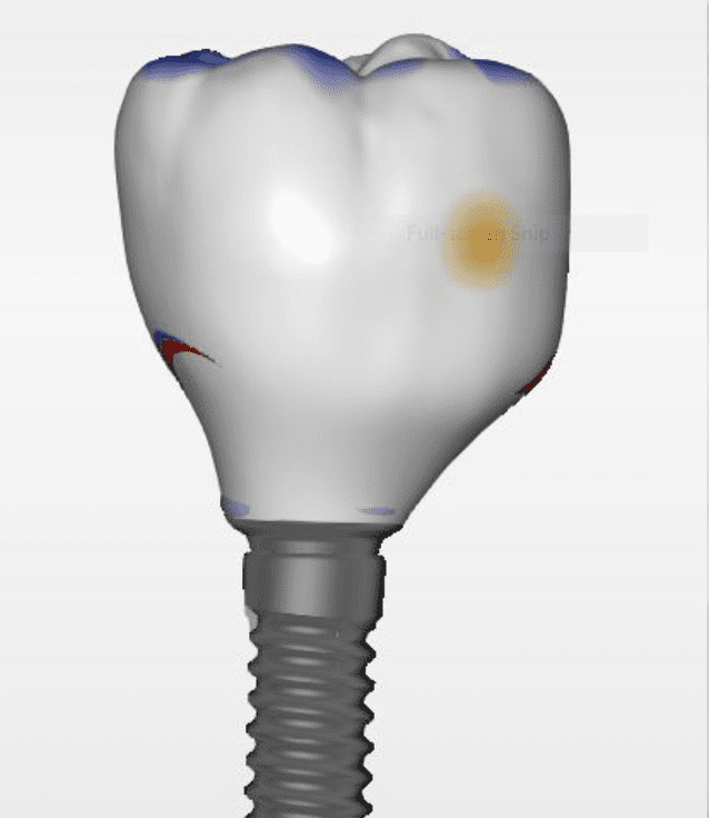 A single tooth with screw