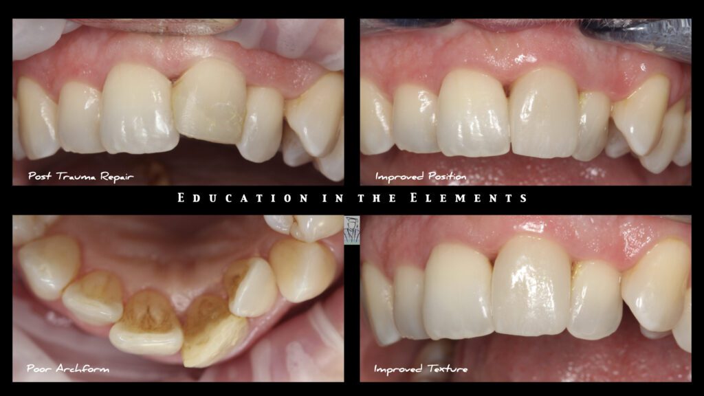 Collage of teeth showing different types of teeth